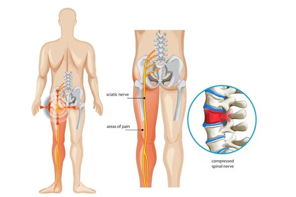 Sciatica