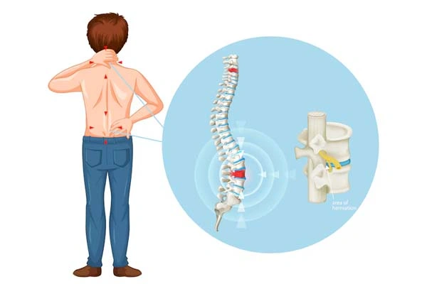 Slipped Herniated Disc