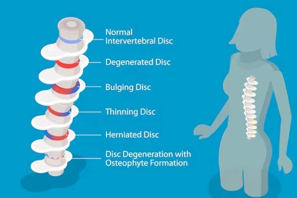 Lumber Degenerative Disc