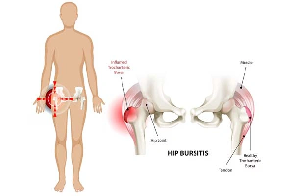 Sacroiliac Joint Pain