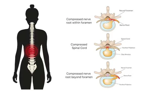 Spinal Stenosis