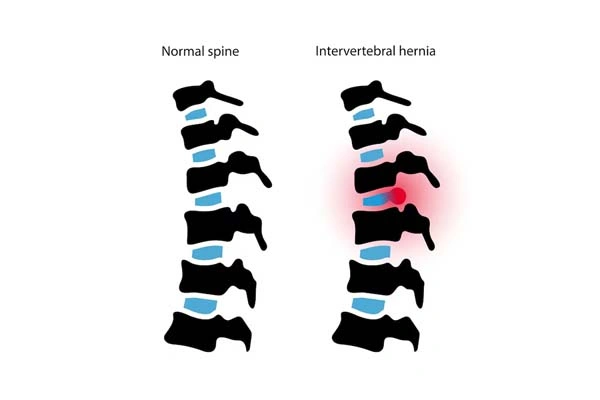 Spondylolisthesis
