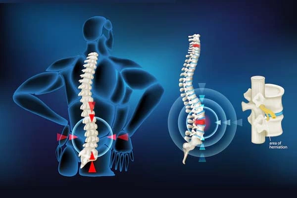 Lumbar Degenerative Disc
